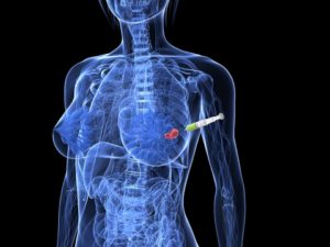 רשלנות רפואית באבחון סרטן השד